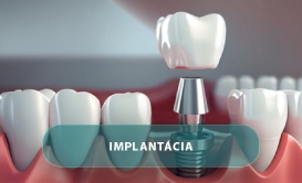 Implantácia