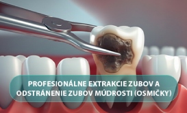 Odstránenie zubov múdrosti