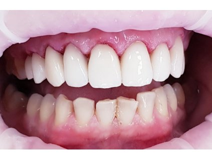 Liečba paradentózy