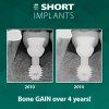 Bicon Short Implant