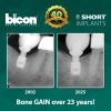 Bicon Short Implant