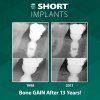 Bicon Short Implant