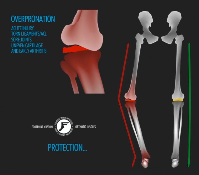 over-pronation