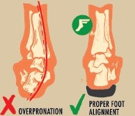 overpronation-ankle