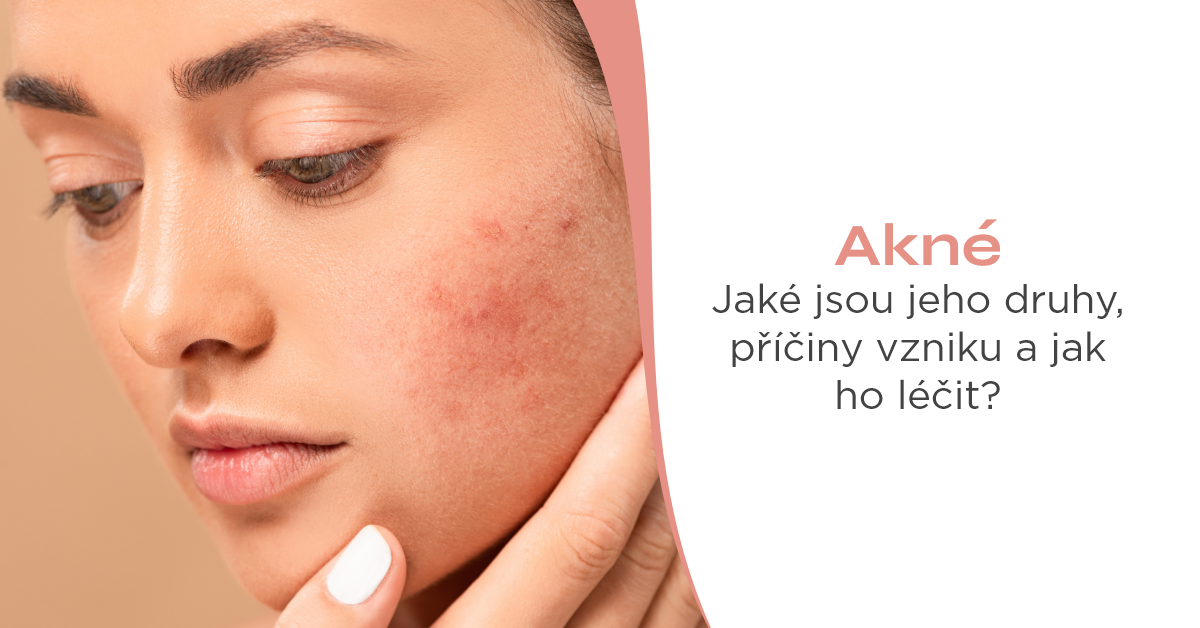 Akné: jaké jsou jeho druhy, příčiny vzniku a jak ho léčit?