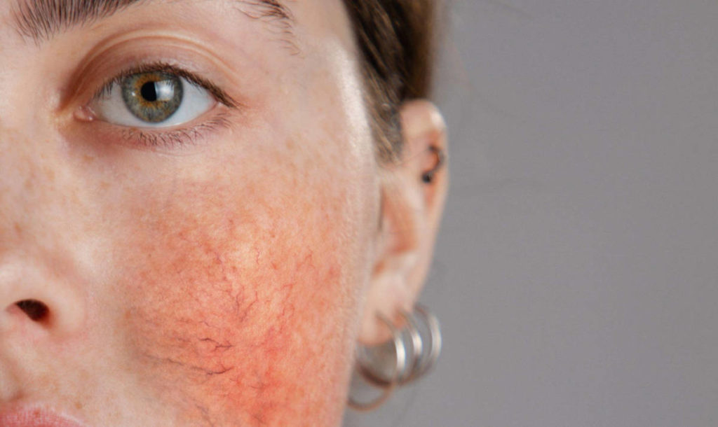 ROSACEA: co to je a proč vzniká?
