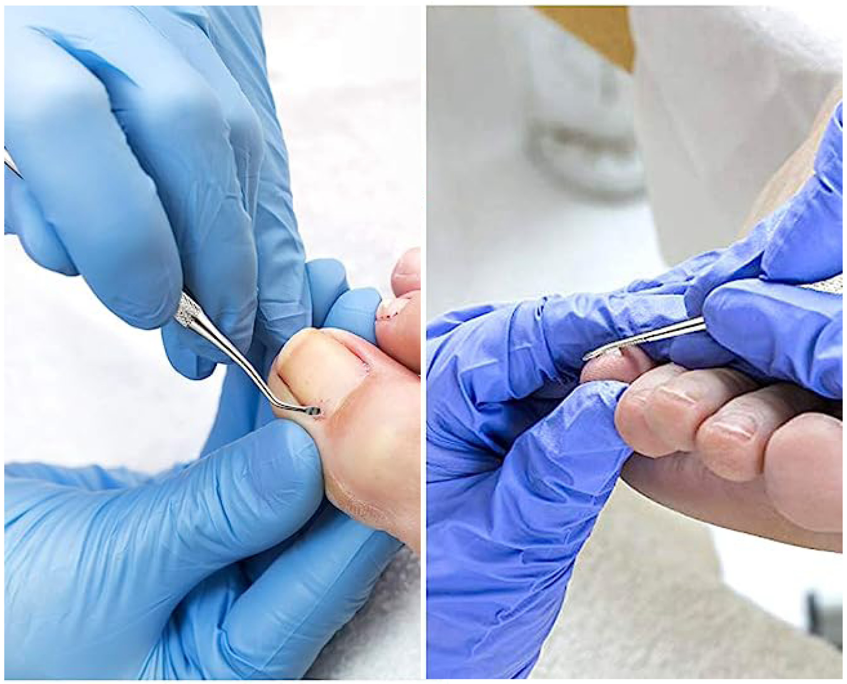 качествен комплект за врастване на нокът