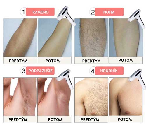 лазерен-епилатор