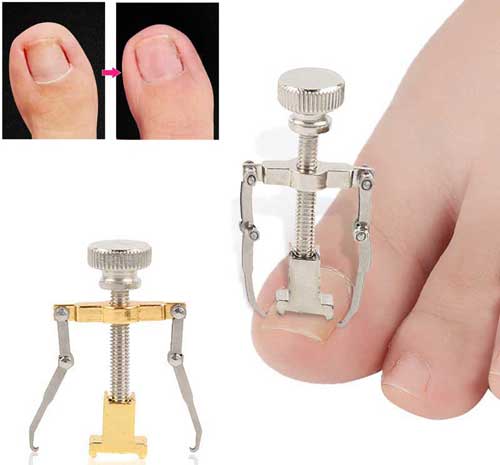 уникална-помощ за врастнали нокти