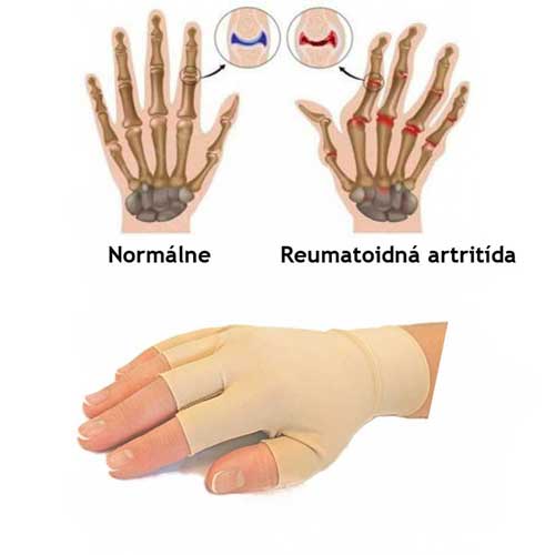 ръкавици-за-ревматизъм