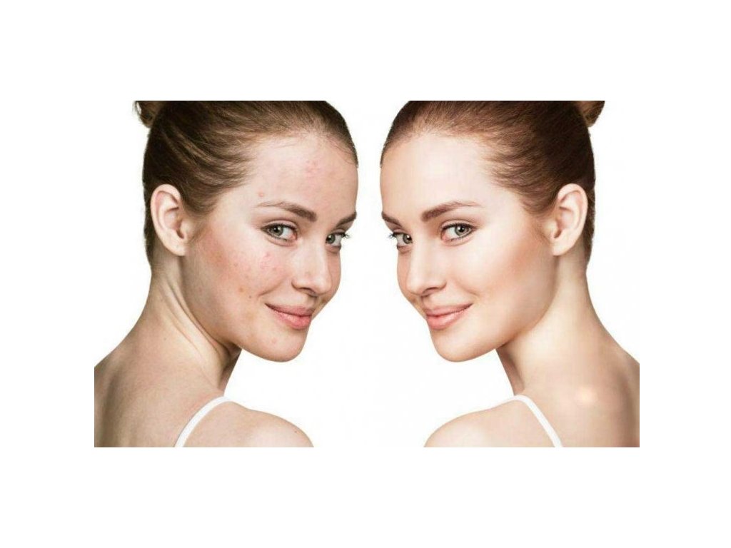 Profesionalni Dermaroller