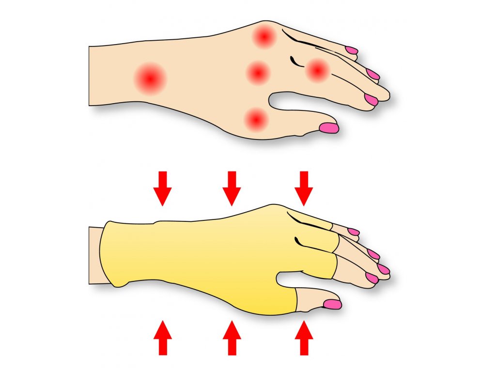 férfiak kezeinek rheumatoid arthritis