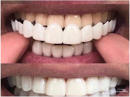 zęby sztuczne