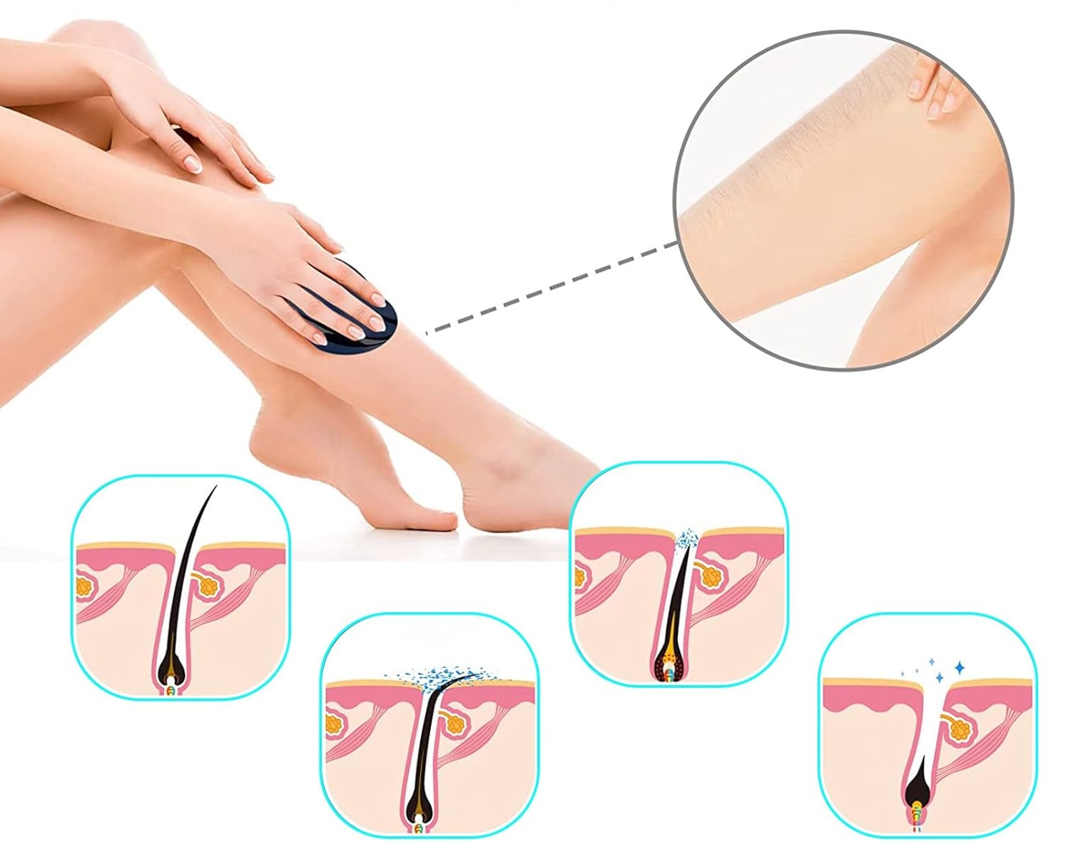 brezbolečinski nanokristalni epilator