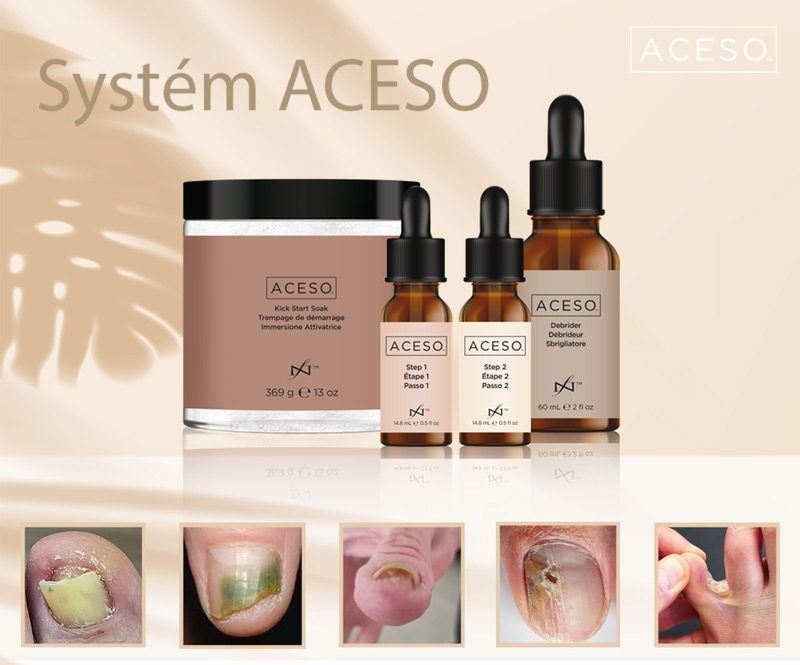 ACESO