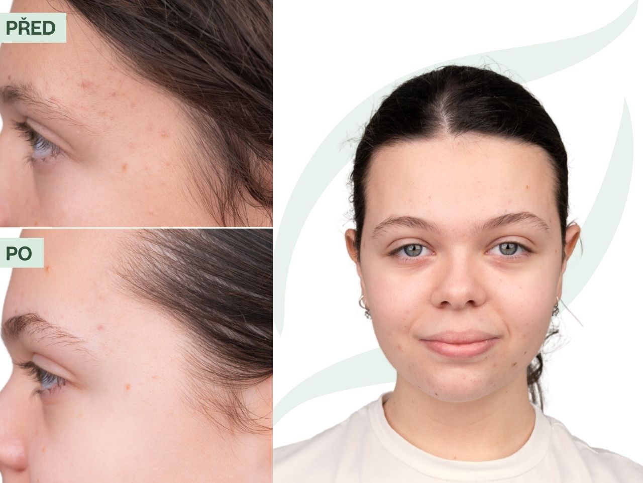 Příběh Klaudie (16) | Akné se mi už tolik neobjevuje a pleť je čilejší