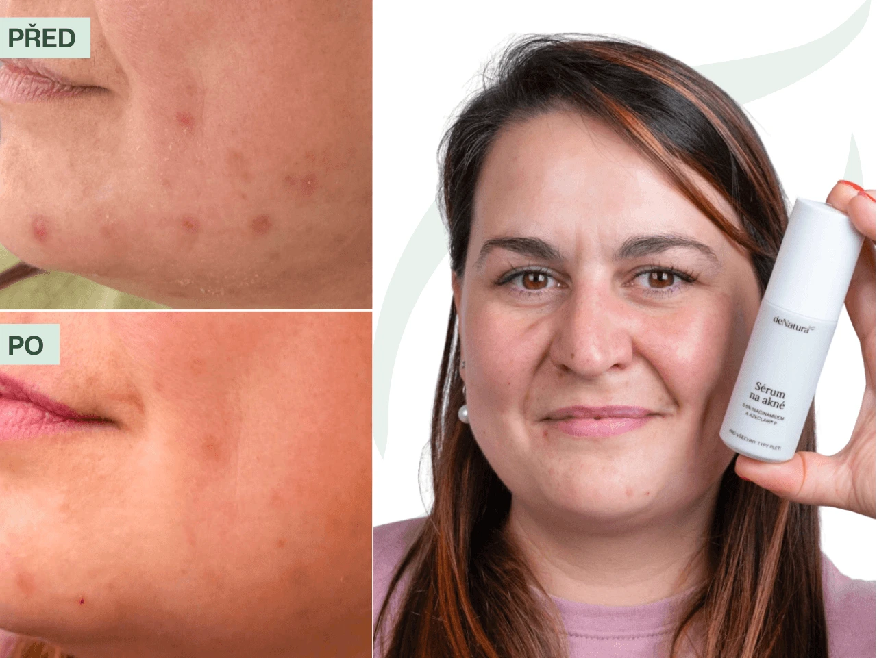 Příběh Kateřiny (33) | Svoji pleť už nemusím skrývat kvůli pupínkům