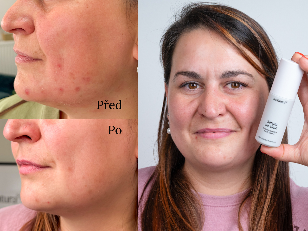 Příběh Kateřiny (33) | Svoji pleť už nemusím skrývat kvůli pupínkům