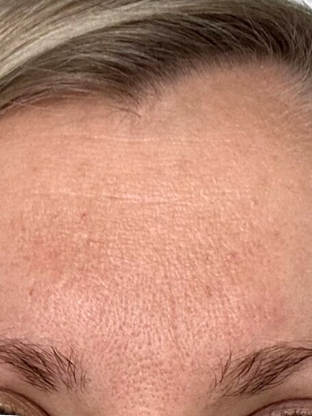 Výsledek Kateřiny L. (30 let) - po: Vypnutá a hydratovaná pleť s méně viditelnými vráskami po používání anti-age séra deNatura.