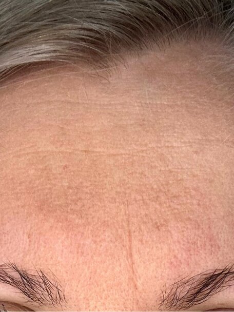 Recenze Kateřiny L. (30 let) - před: Hlubší vráska mezi obočím a jemné vrásky kolem očí a na čele před používáním anti-age séra deNatura.