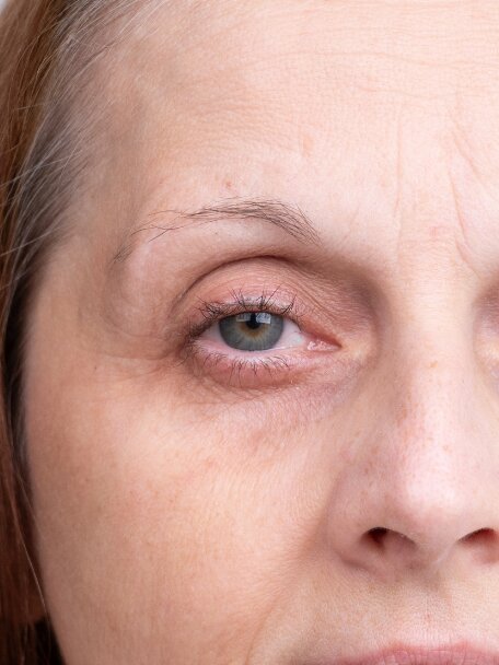 Recenze Heleny (55 let) - před: Vysušená, šedivá a mdlá pleť s vráskami kolem očí před používáním anti-age séra deNatura.