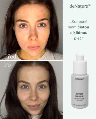 Ne, tohle není retuš. 👀✨ Tohle je výsledek pravidelné péče s naším přírodním Sérem na akné. 🌿 Díky kombinaci 5%...