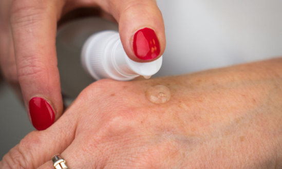 Pigmentové škvrny: príčiny, prevencia a účinné riešenia