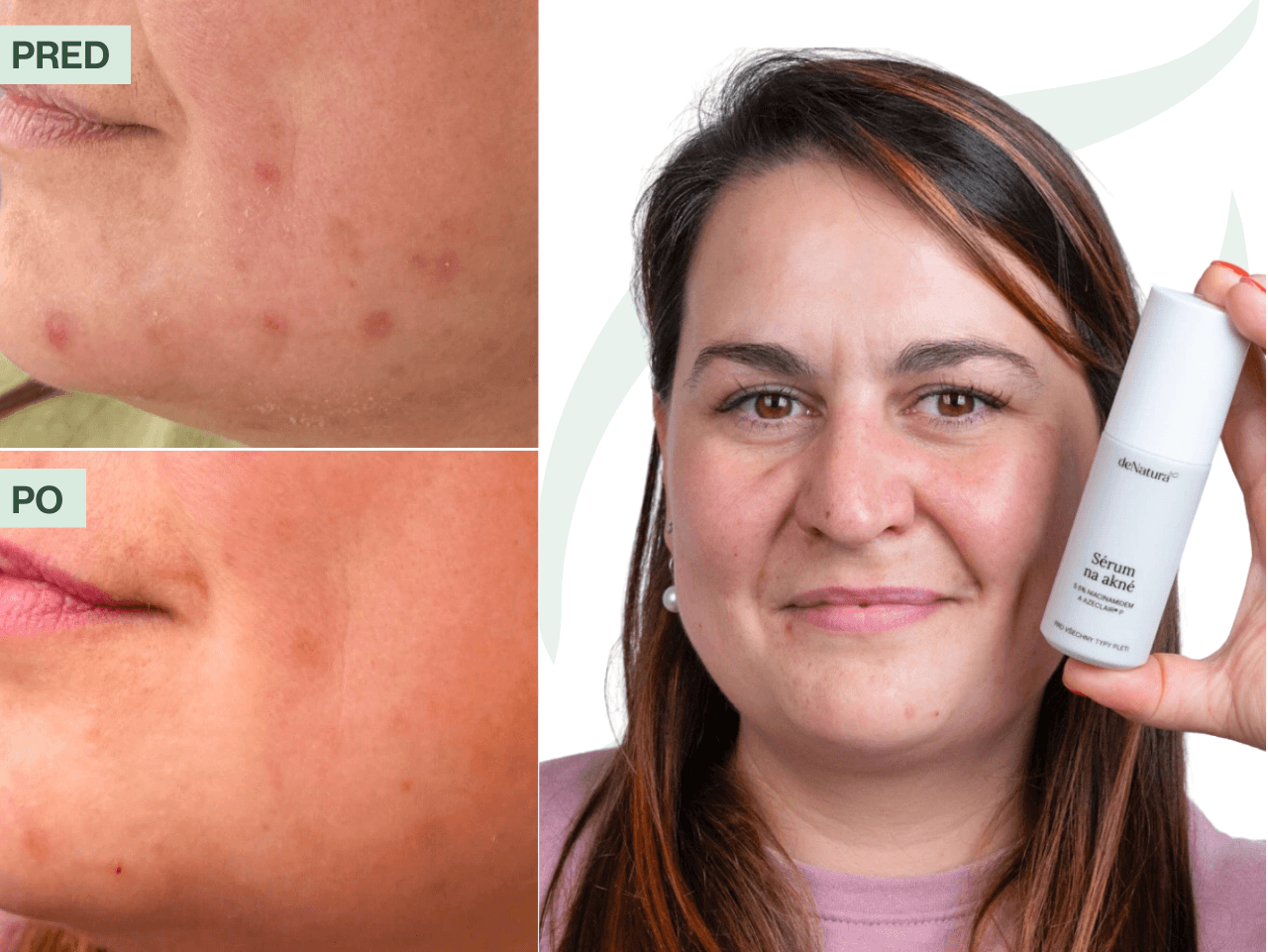 Príbeh Katky (33) | Svoju pleť už nemusím skrývať kvôli vyrážkam