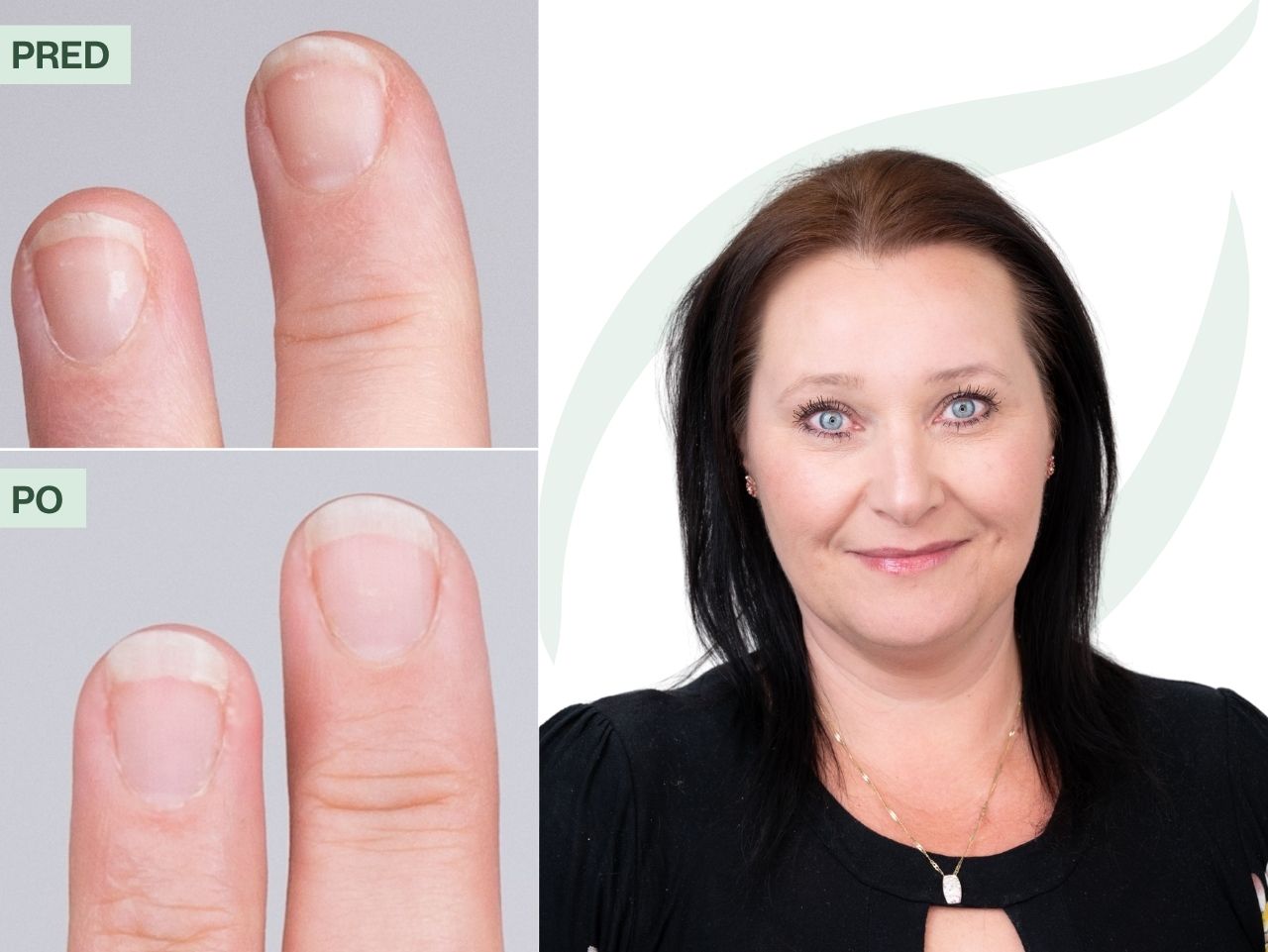 Linda (51) | Moje vlasy aj nechty sa prestali lámať už po mesiaci