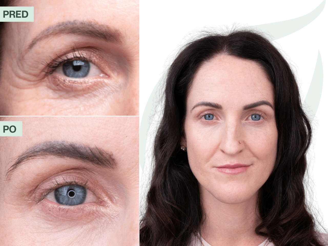 Príbeh Zuzany (38) | Moja pleť bývala málo šťavnatá