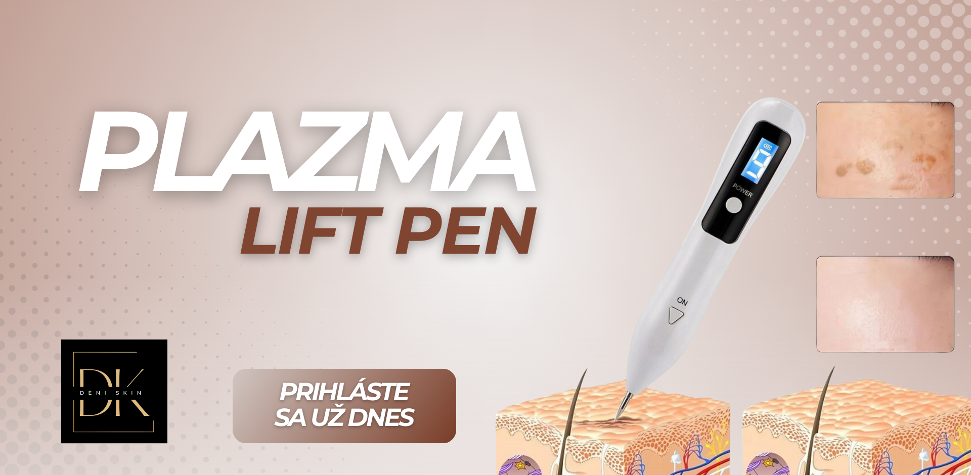 FACE LIFTING Z PLAZMA LIFT PENOM