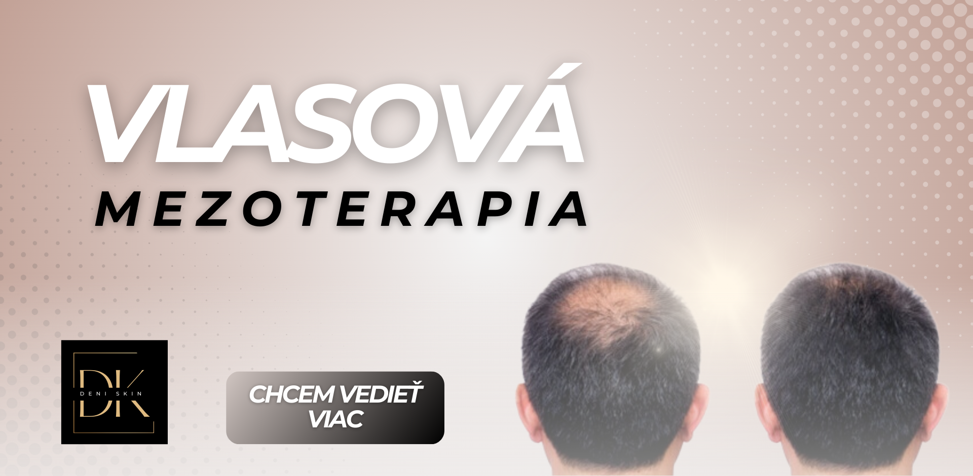 Vlasová mezoterapia: čo to je a ako vám môže pomôcť