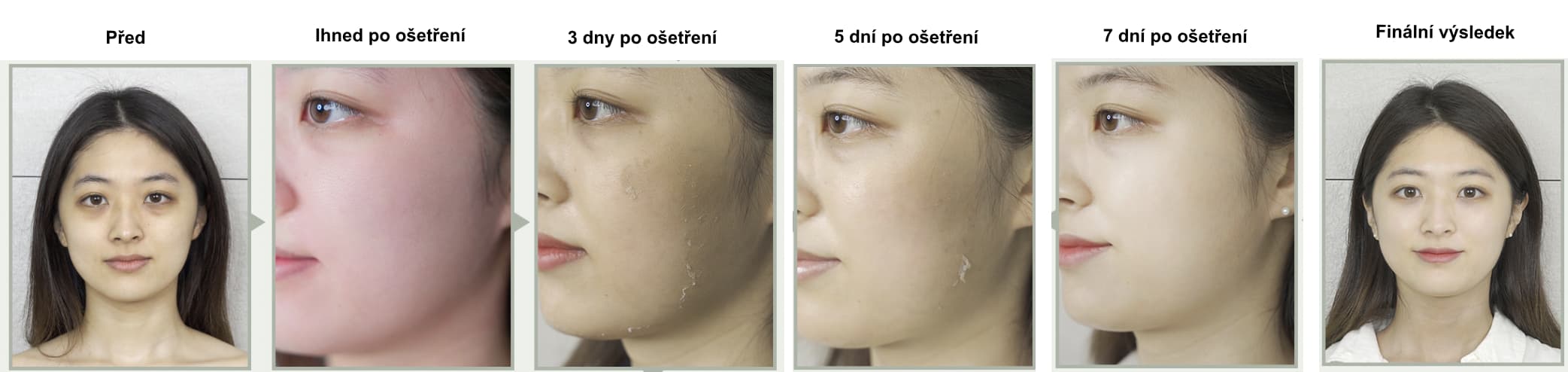 Biomicroneedling vysledky