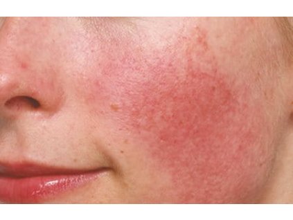 EUC INT AS indication rosacea and couperose 01