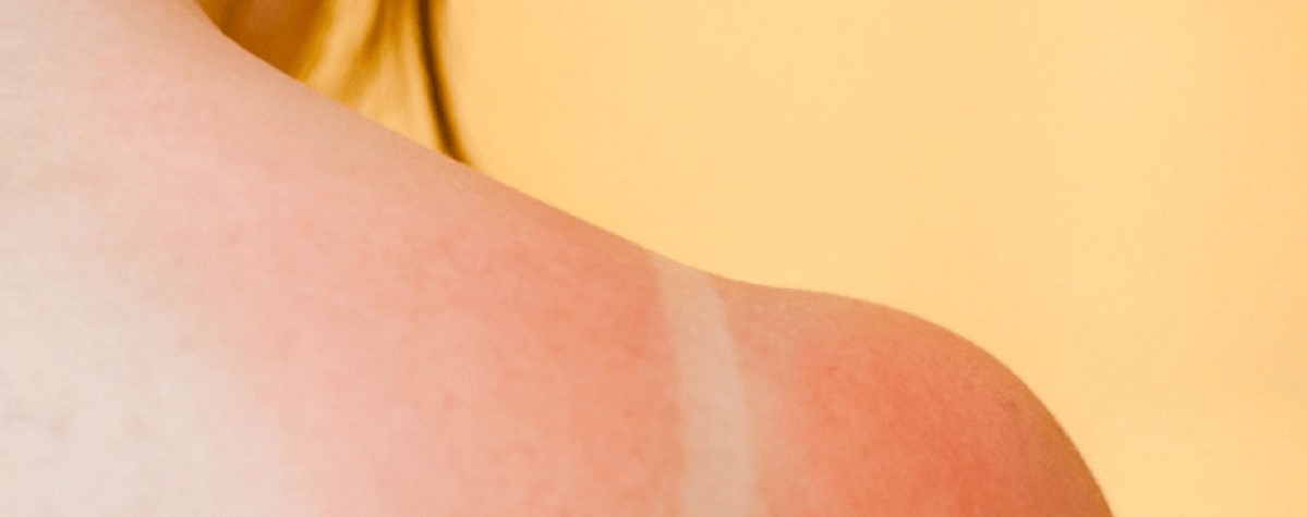 Co je spálení sluncem?