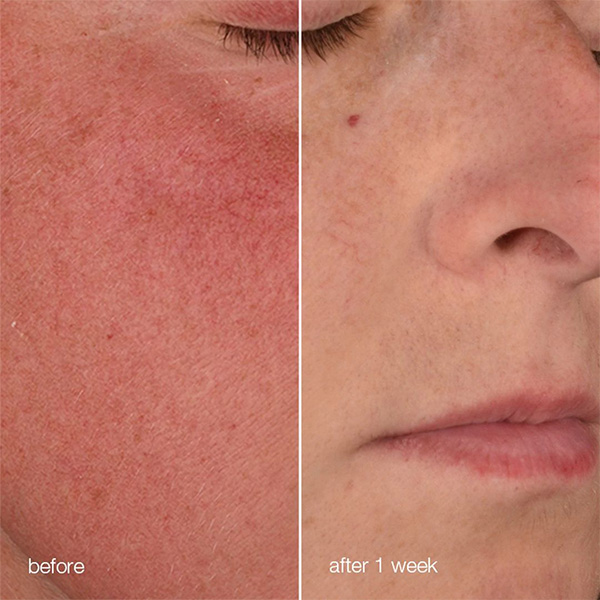 Dermaplaning treatment