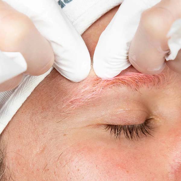 Dermaplaning ošetření