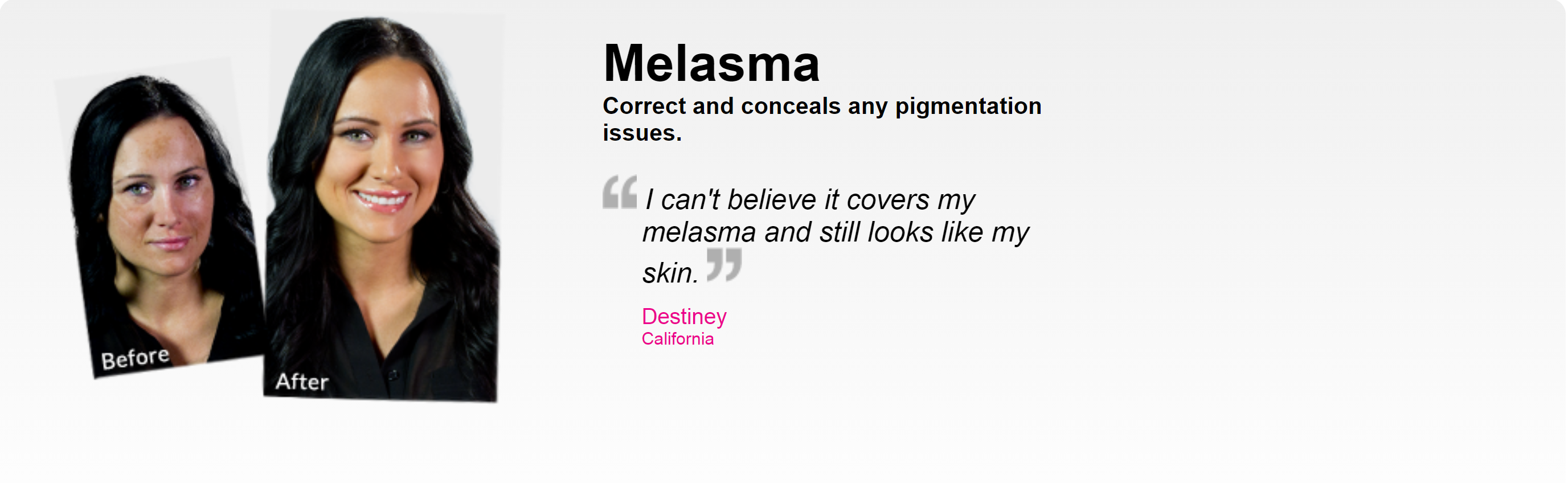 Melasma