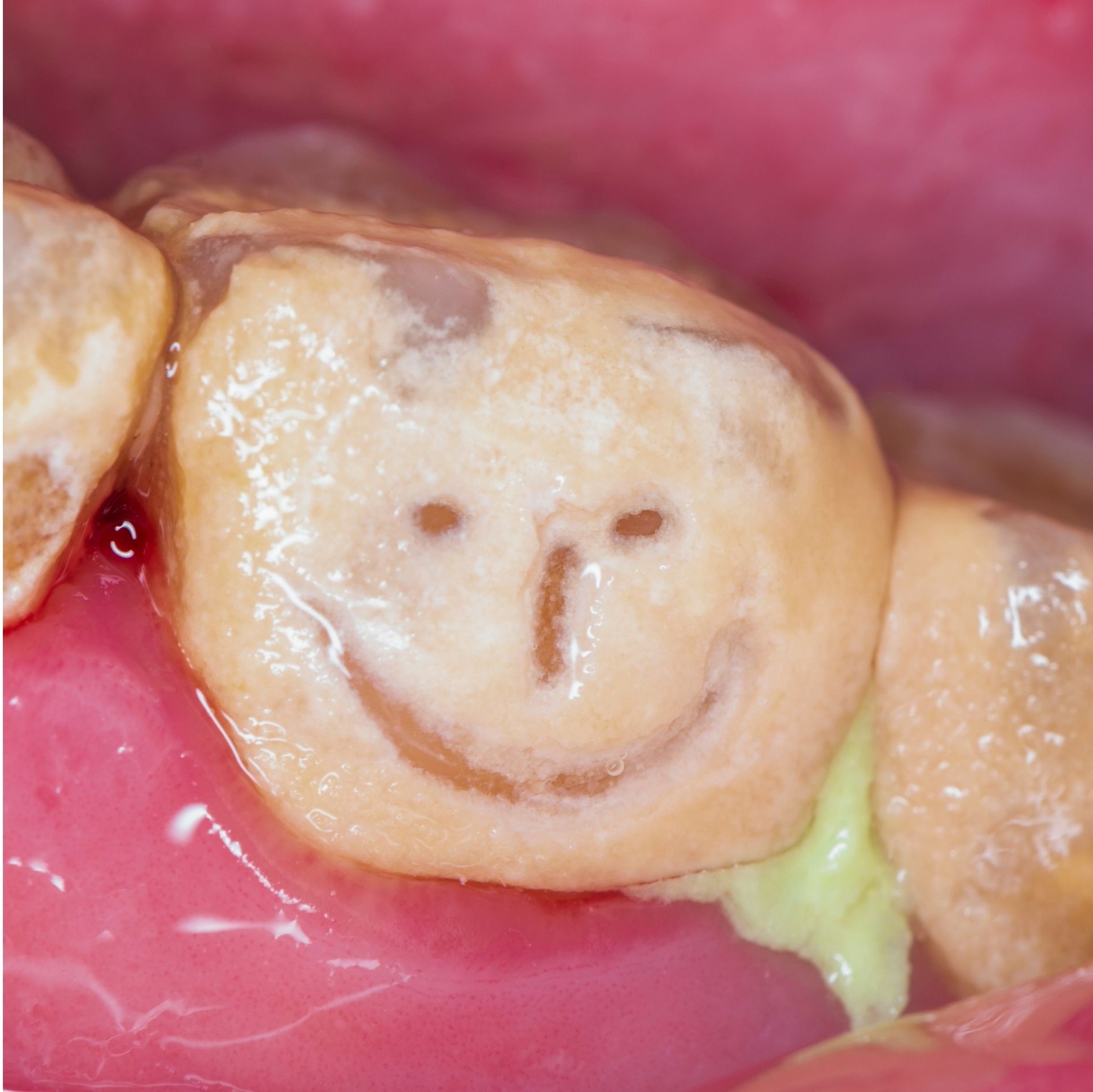 Zubní kámen: proč se tvoří a co opravdu pomáhá