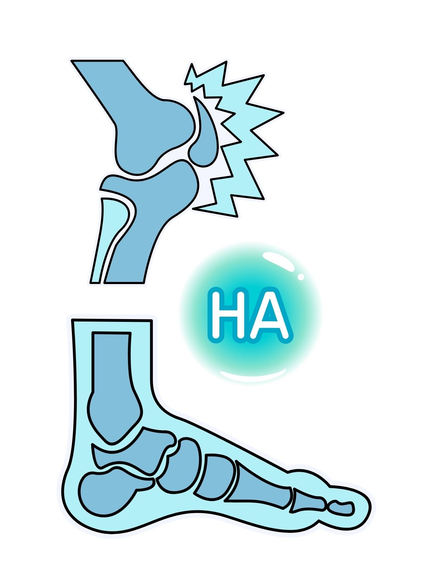 Kyselina hyaluronová v ortopedické praxi: Možnosti intraartikulární aplikace
