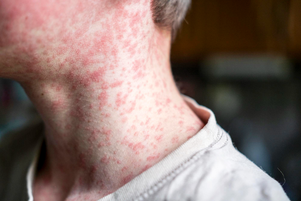 Příznaky alergie na slunce – detail krku a šíje s červenou svědivou vyrážkou a zarudlými pupínky na kůži