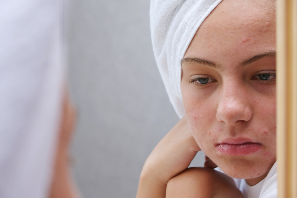 problematicka-plet-akne-pece-o-plet-prirodni-lecba-kontryhel-na-akne-hormonalni-rovnovaha-kontryhel-caj-ucinky-kontryhelova-tinktura-pletove-problemy
