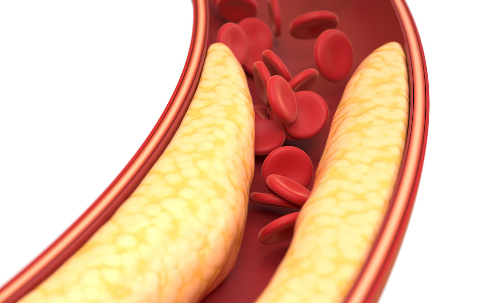 Zanesená tepna s červenými krvinkami – ilustrace vysokého cholesterolu, který může Reishi přirozeně pomoci regulovat