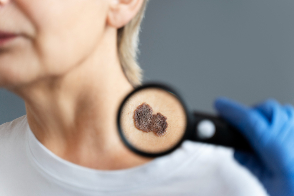 Dermatologické vyšetření kůže pod lupou – riziko poškození pokožky v důsledku UV záření.


