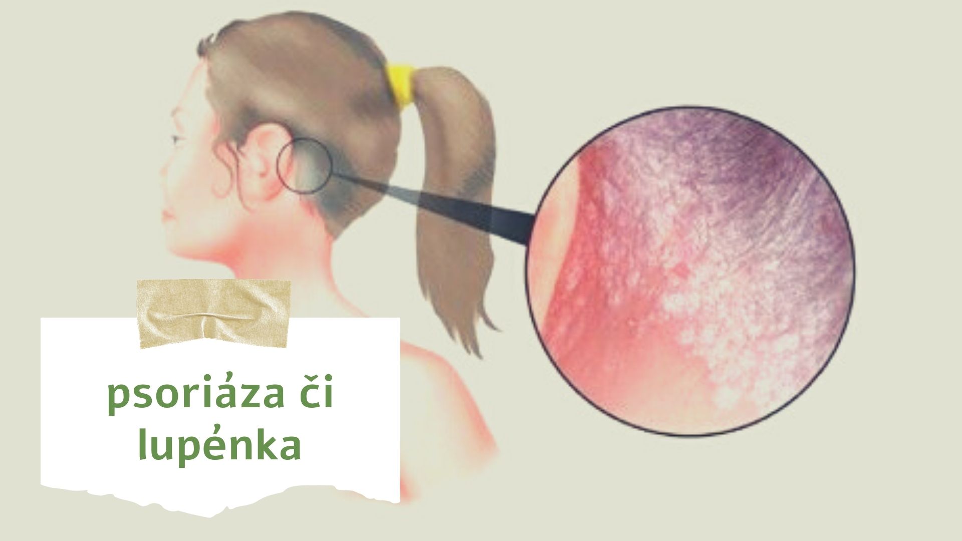 Trápí mě: Psoriáza či lupénka