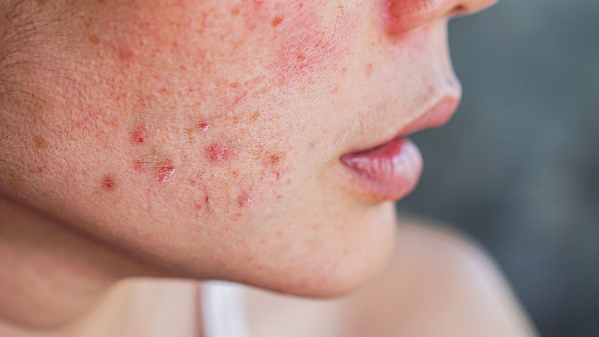 Akné ako systémový problém – hormóny, bariéra kože a chyby v rutine