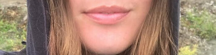 pred-lip-fillers