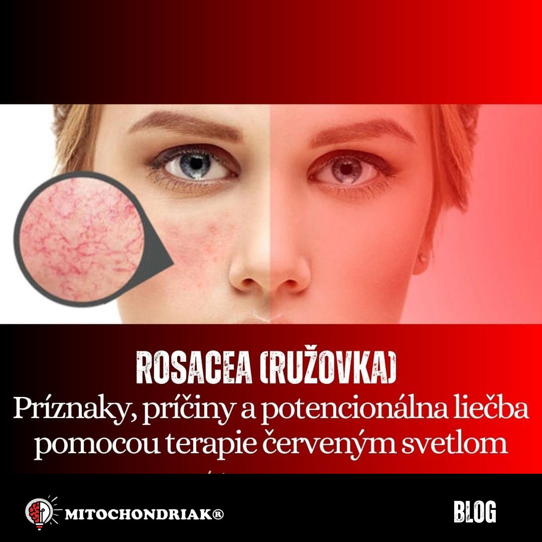 Rosacea (ružovka) – Príznaky, príčiny a terapia červeným a infračerveným svetlom