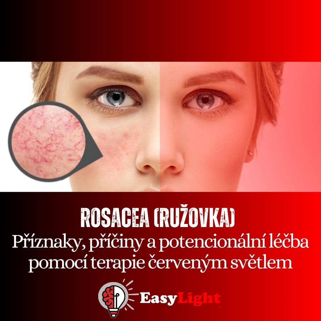 Rosacea (růžovka) – příznaky, příčiny a terapie červeným a infračerveným světlem