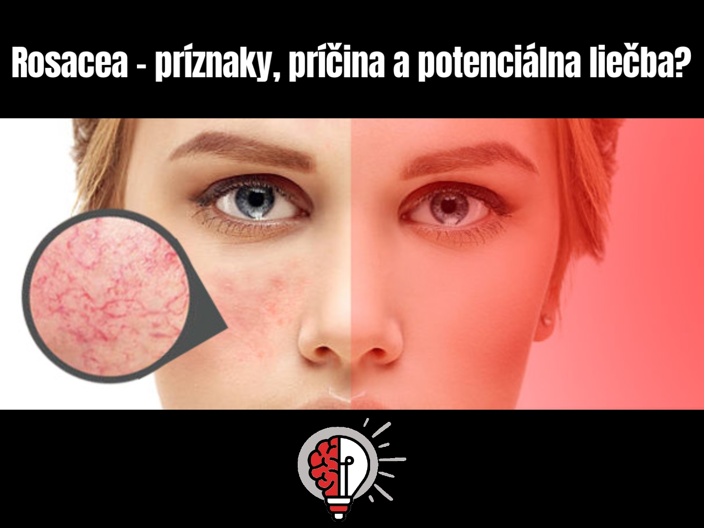 Rosacea (růžovka) – příznaky, příčiny a terapie červeným a infračerveným světlem